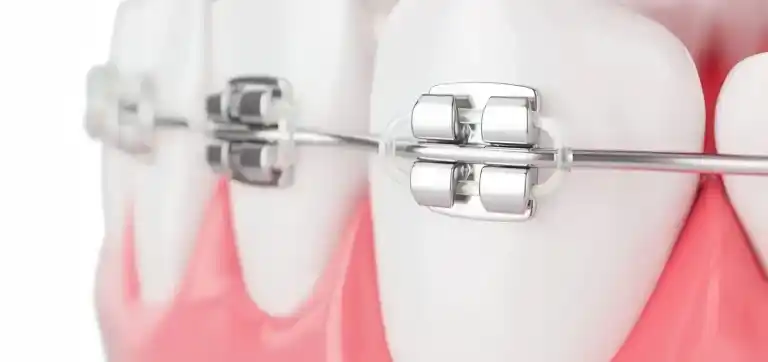 Veneers vs Whitening: Which Is Right for You?